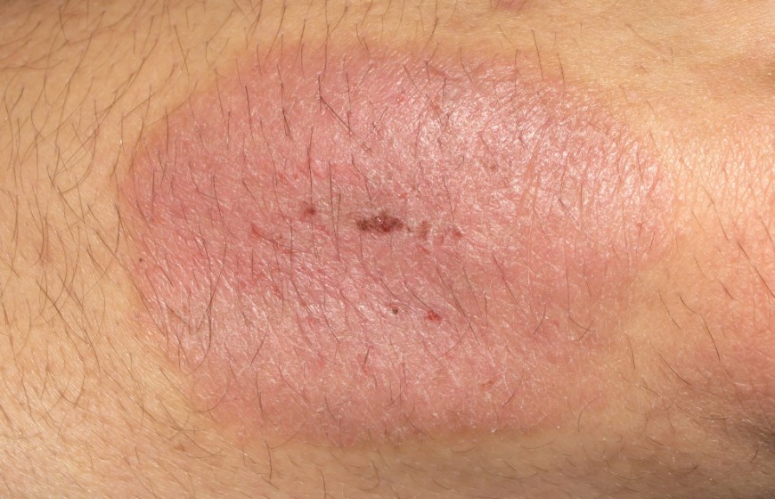 Therapiem glichkeiten Bei Schuppenflechte Wellnesskomplett